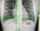 Researchers detect long-Covid’s impact via simple chest X-rays