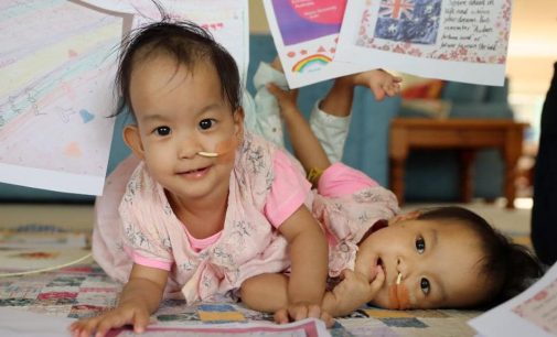 Conjoined Bhutanese twins undergo separation surgery